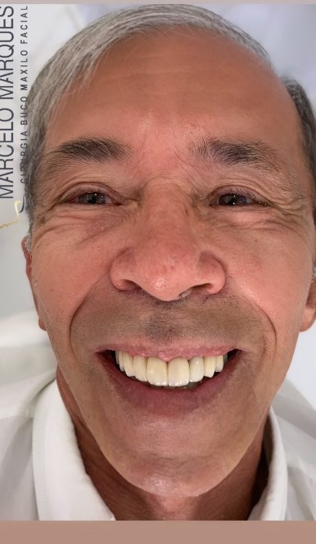 Depois: sorriso renovado com implante dentário e prótese