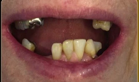 Antes da prótese protocolo: arcada com perda de dentes