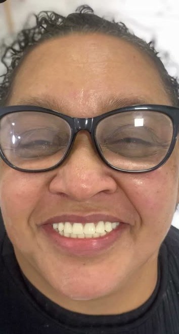 Depois: sorriso reabilitado sobre implantes dentários
