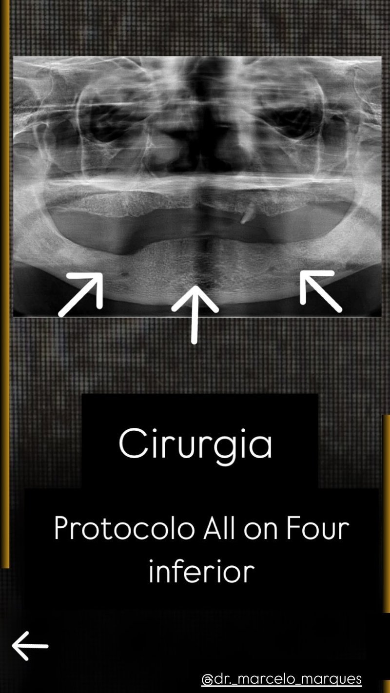 Radiografia de prótese protocolo All on Four inferior planejada pelo Dr. Marcelo Marques