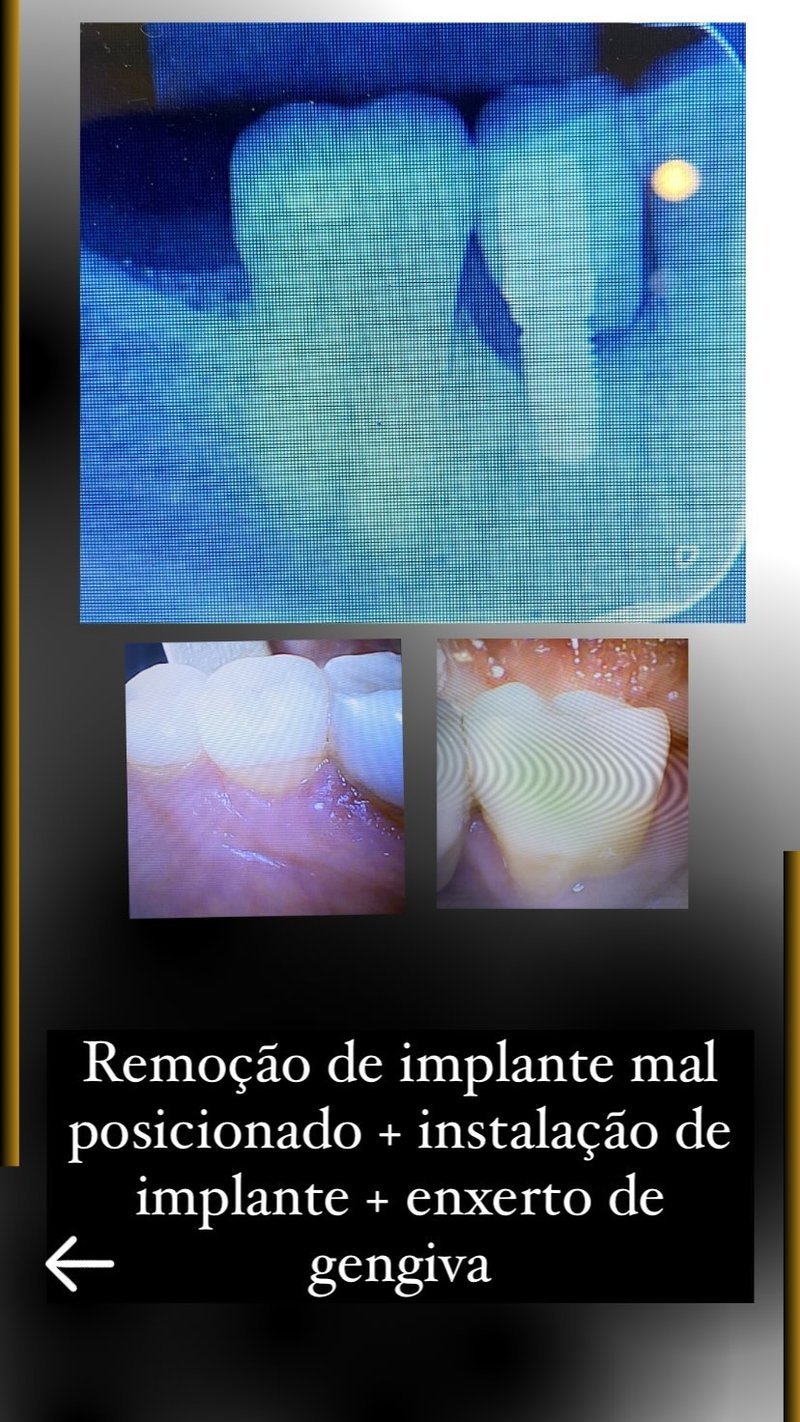 Instalação de implante dentário com enxerto de gengiva
